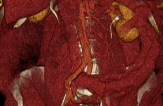 3D digital reconstruction of the aorta, kidneys, and surrounding tissues and muscles.