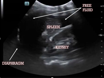 Annotated LUQ showing diaphragm, spleen, kidney and free fluid