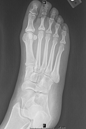 Toothpick in Foot XR not visible