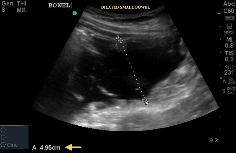 dilated small bowel